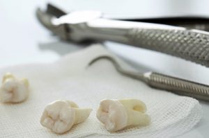 Как удалить зуб