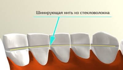 Как укрепить шатающиеся зубы