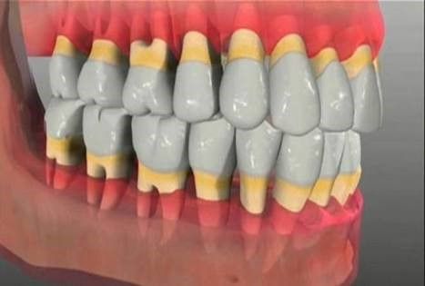Как укрепить шатающиеся зубы