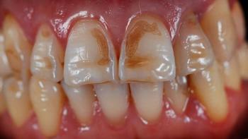 Как распознать разрушение зубной эмали