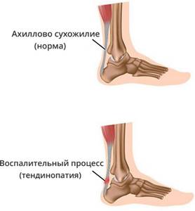 Ахиллесово сухожилие болит при ходьбе лечение картинки